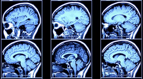 Criminal Minds Are Different From Yours, Brain Scans Reveal Brain scans