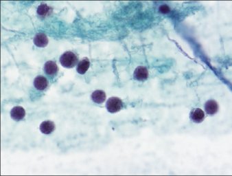 CytoJournal: Free Full text articles from open access peer Merkel cell carcinoma